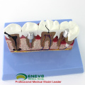 DENTAL35 (12625-1) Implante dental de gran tamaño Modelos didácticos de anatomía médica